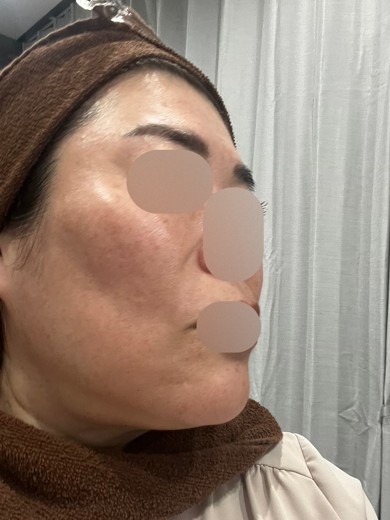 before photo: ヴェルベットスキン
