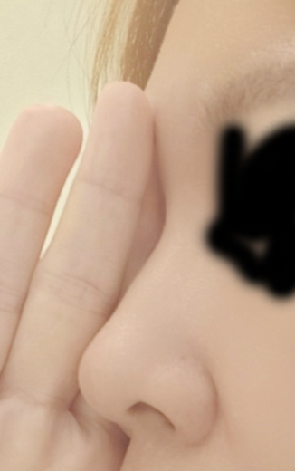before photo: 콧대(보형물), 코끝(자가연골)