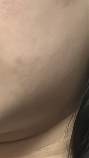 after photo: 脂肪溶解注射(顔)