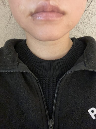 before photo: 턱끝보톡스, 턱끝필러