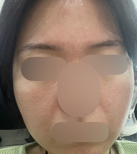 after photo: 여드름주사, 네오빔