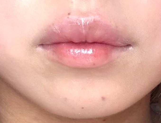 after photo: 口角ボトックス