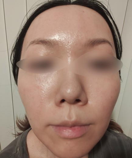 after photo: 水光注射
