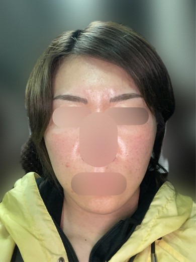 after photo: 脂肪溶解注射(顔)