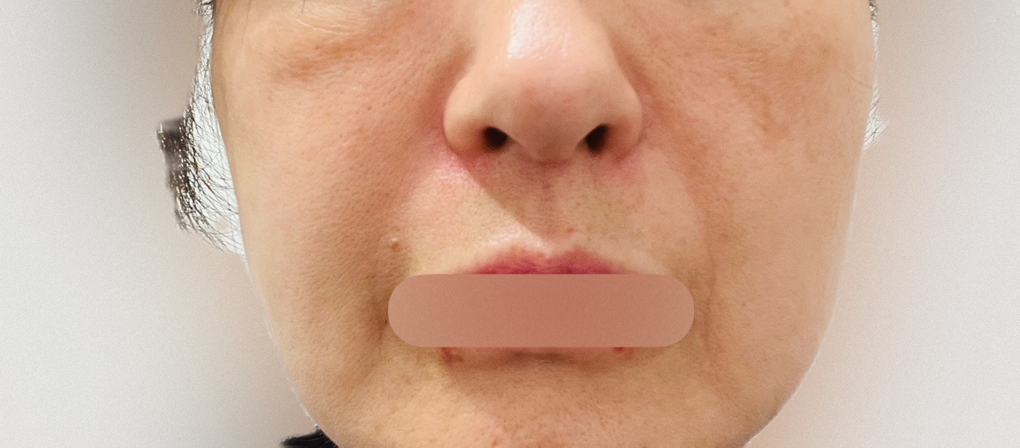 イタリア製 ♧ 口顎首のEx-voto ポテンツァ ダイヤモンドチップ（全顔300ショット）たるみ・引き締めに