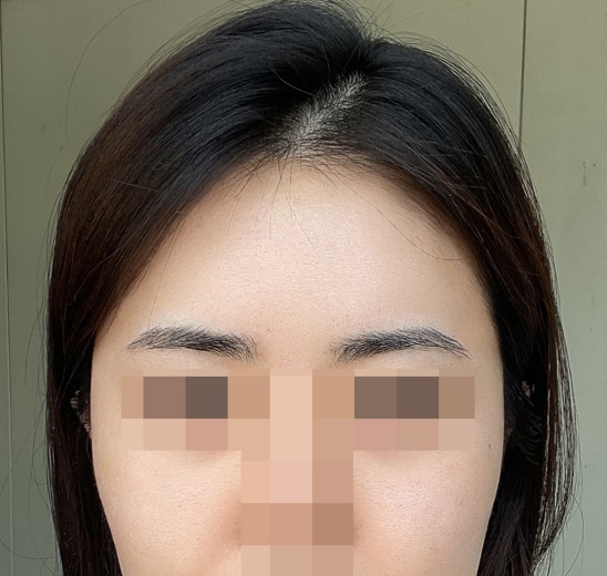 after photo: 이마필러