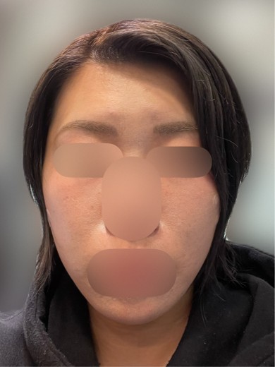 before photo: 脂肪溶解注射(顔)