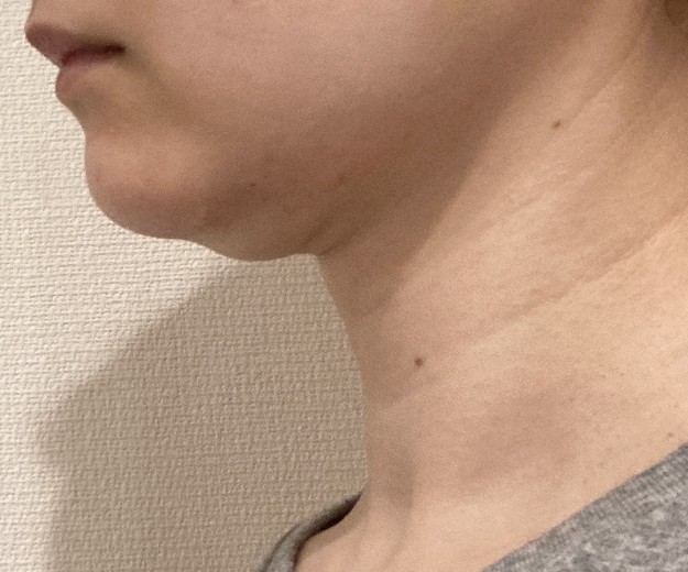 before photo: 脂肪溶解注射(顔)