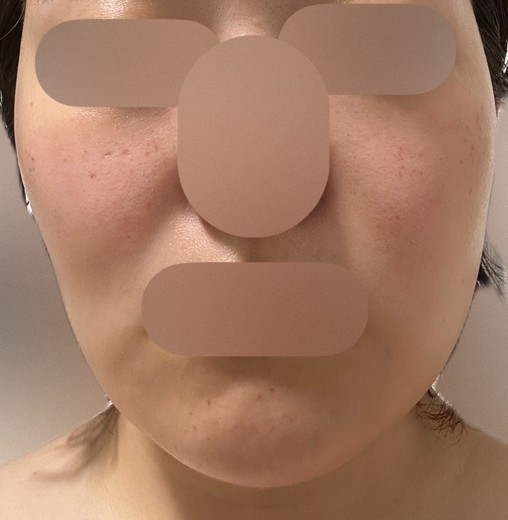 after photo: ルメッカ