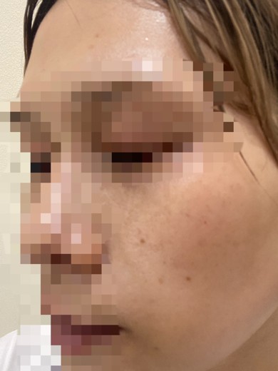 before photo: IPL(光/フォト治療), ピーリング