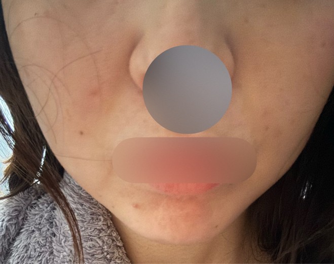 after photo: 脂肪溶解注射(顔)