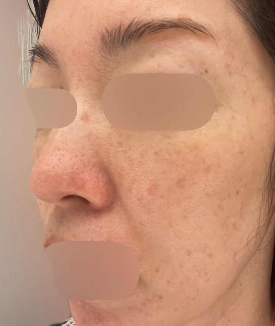 ピコスポットシミ取り（顔）※個数制限なし【2月28日迄にご予約頂いた方