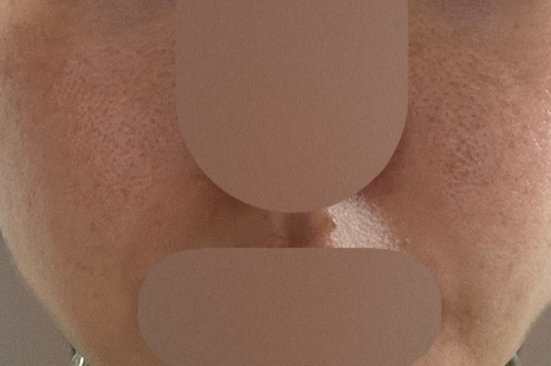 after photo: 리쥬란힐러