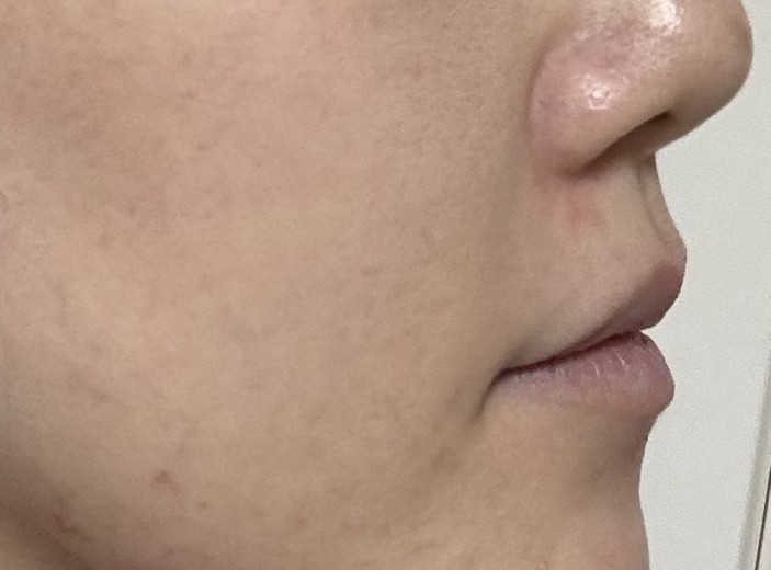 after photo: IPL(光/フォト治療), ピーリング, エレクトロポレーション, ルメッカ