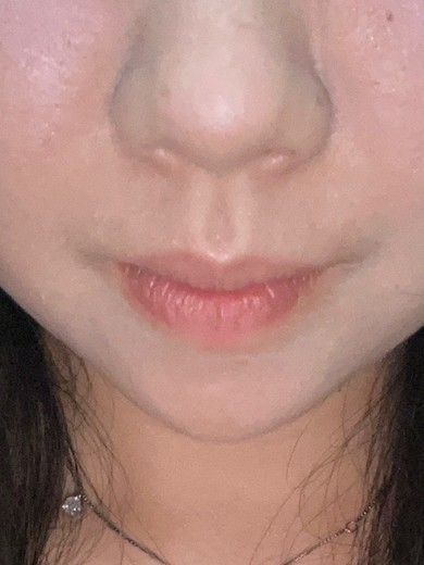 after photo: 脂肪溶解注射(顔)