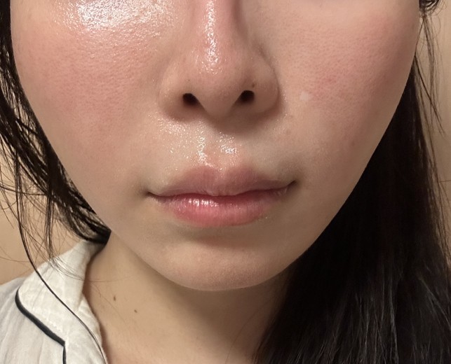 after photo: IPL(光/フォト治療)