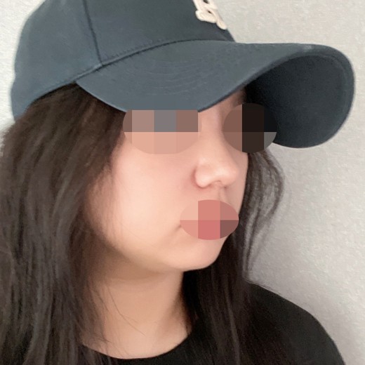 after photo: 콧볼축소