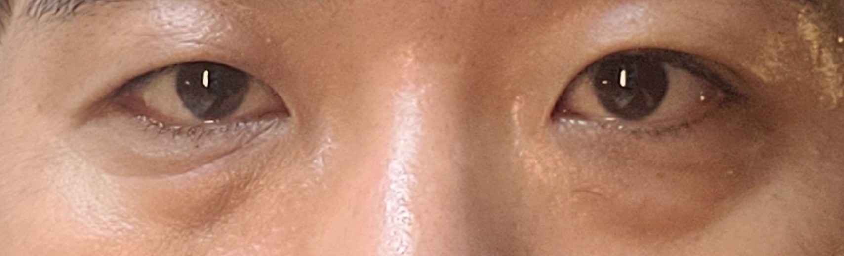 before photo: 눈밑지방재배치