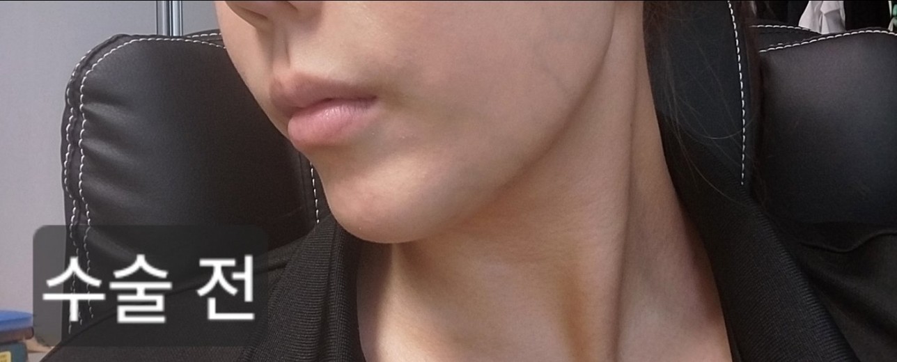 before photo: 턱끝보형물제거
