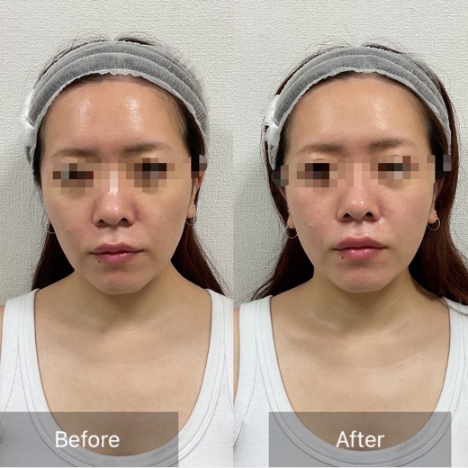 before photo: ピーリング, チタニウムリフト