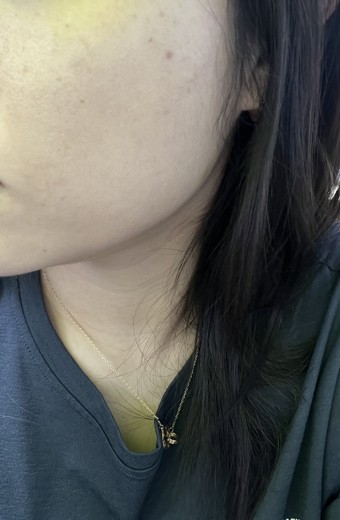 after photo: 사각턱보톡스