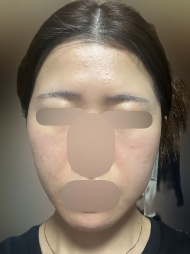 after photo: ピーリング, エレクトロポレーション