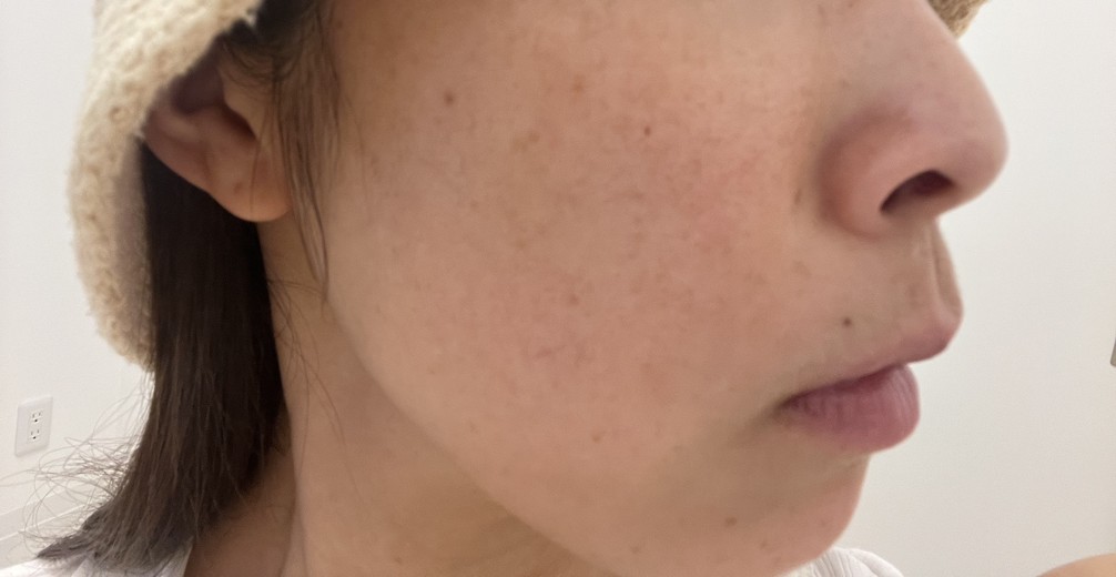 before photo: ピコトーニング, ピコフラクショナル