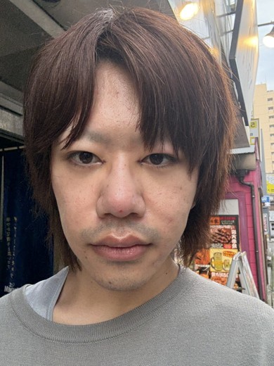 after photo: 脂肪溶解注射(顔)