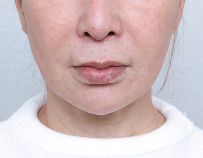 before photo: 실리프팅