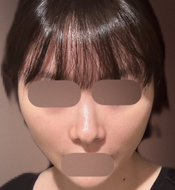 エレクトロポレーション【再来OK】 | ライズワン美容皮膚科クリニック