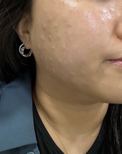 after photo: 윤곽주사