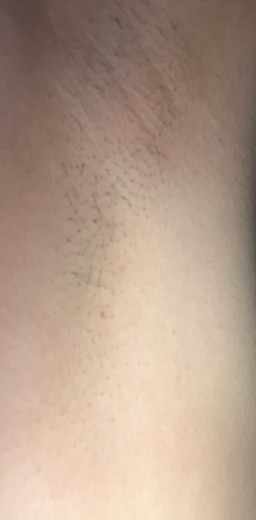 after photo: 겨드랑이제모