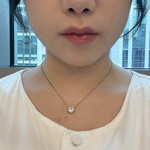 before photo: 사각턱보톡스