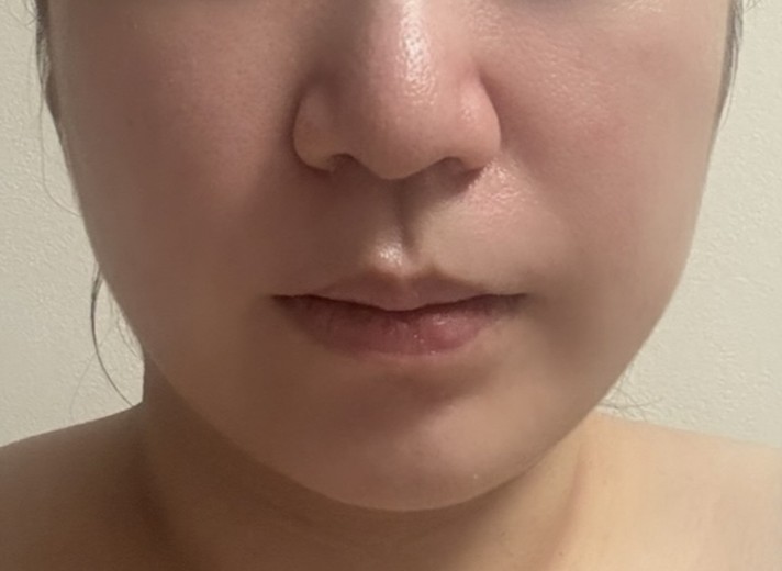 before photo: リニアファーム(ハイフ)
