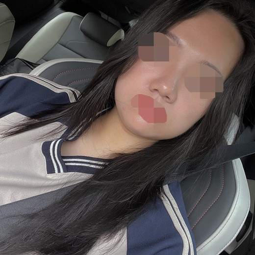 before photo: 콧볼축소