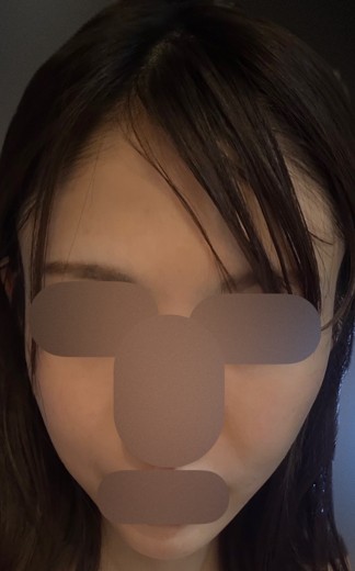after photo: マッサージピール(コラーゲンピール)