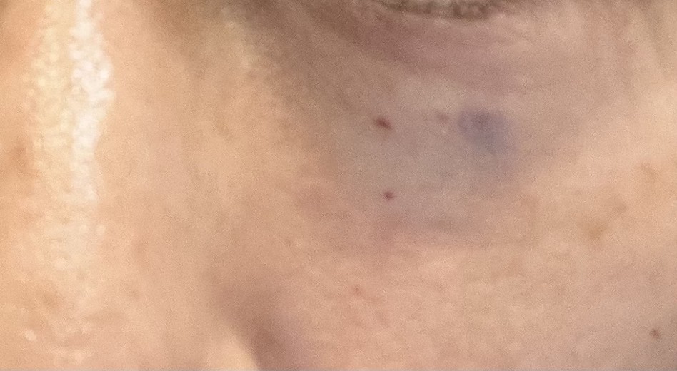 after photo: サーモン注射