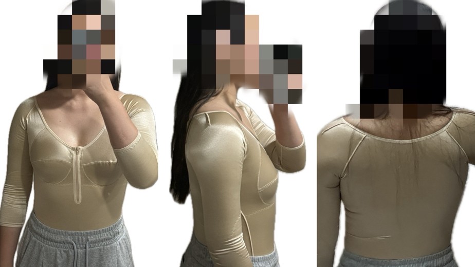 after photo: 팔지방흡입, 옆구리지방흡입, 복부지방흡입, 허리지방흡입