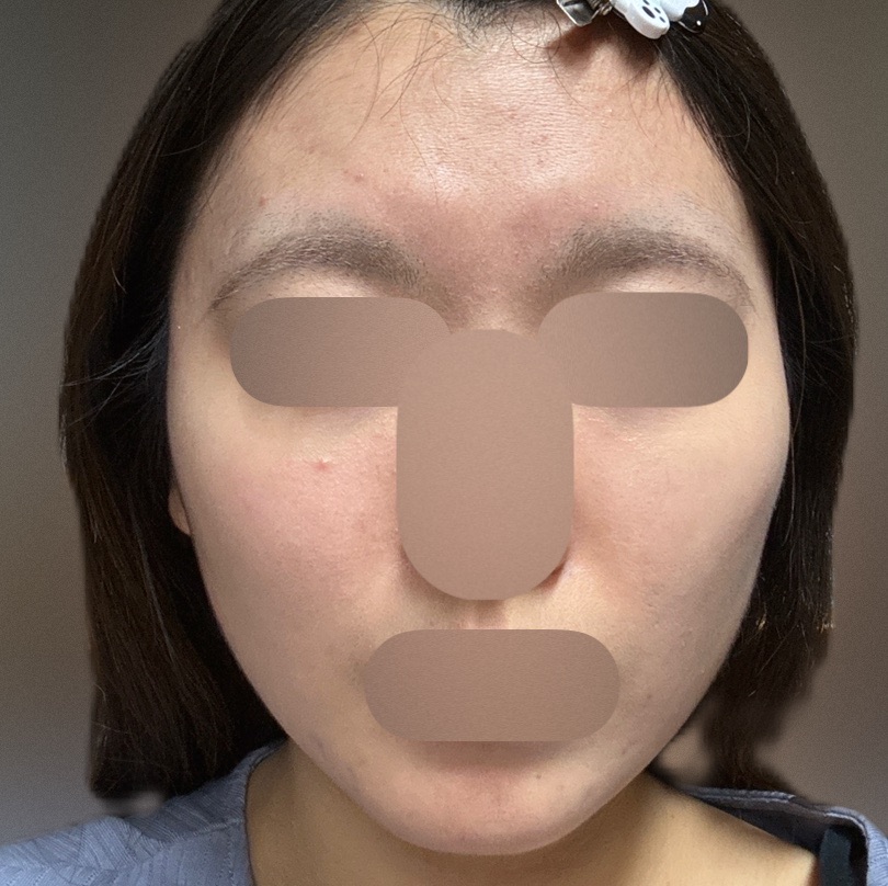 再来OK】エラ ボツリヌストキシン注射 | シティタワー新宿クリニック