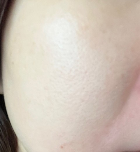 before photo: マッサージピール(コラーゲンピール)