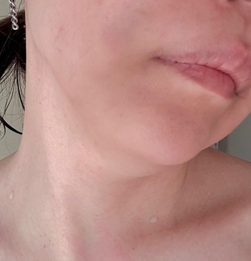 after photo: 脂肪溶解注射(顔)