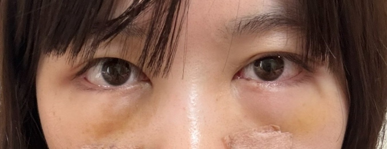 after photo: 目の下脂肪再配置(ハムラ・裏ハムラ法)