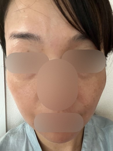 before photo: 水光注射