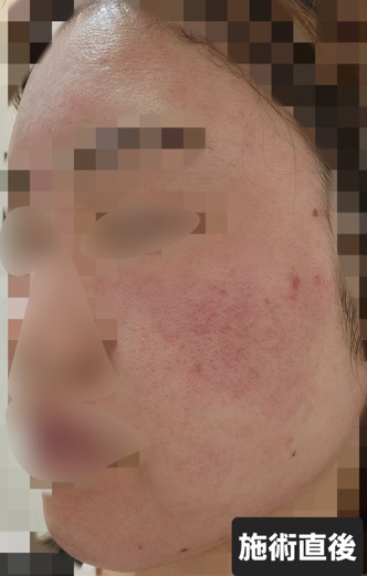 after photo: ダーマペン