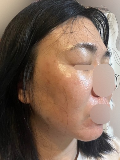 after photo: フラクショナルレーザー