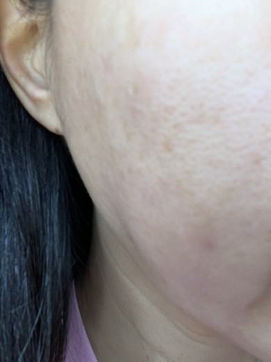 before photo: 턱필러