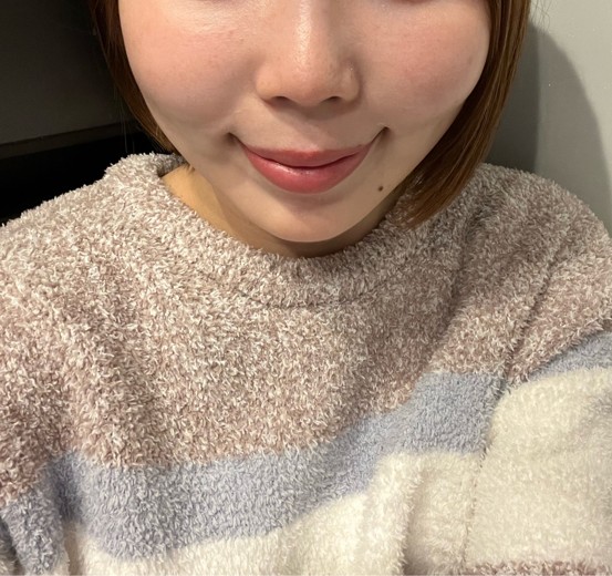 after photo: 脂肪溶解注射(顔)