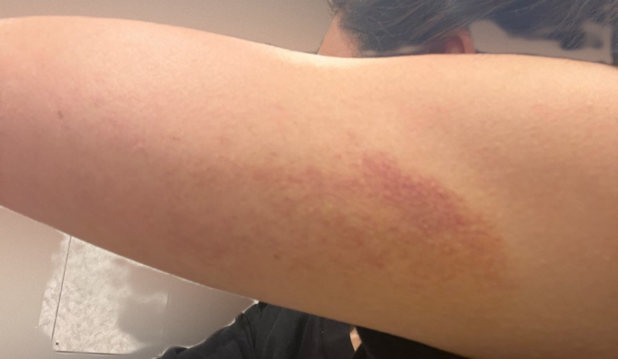 after photo: 脂肪冷却(腕), 脂肪冷却(太もも)