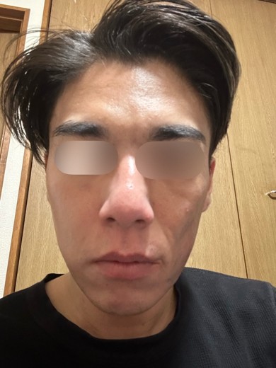 after photo: ダーマペン, エクソソーム