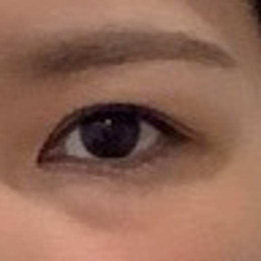 before photo: 涙袋ヒアルロン酸